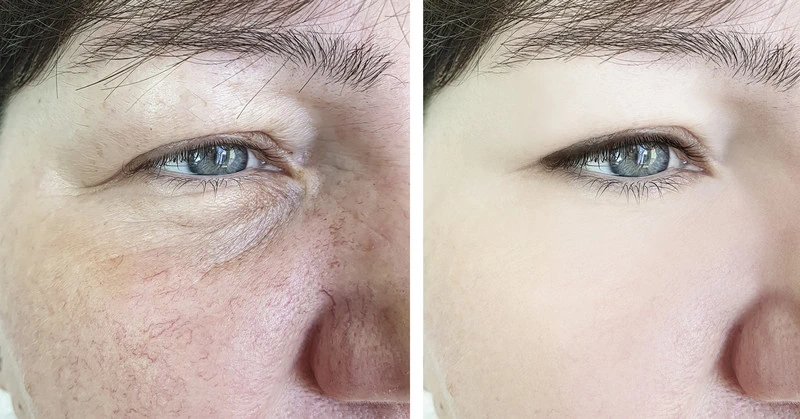 Before and after picture of red vein laser treatment