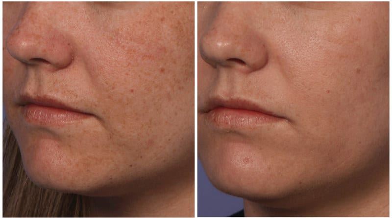 Mini Fraxel Laser Clear and Brilliant before-and-after