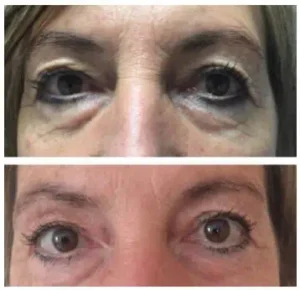 Eyelid lift top and bottom