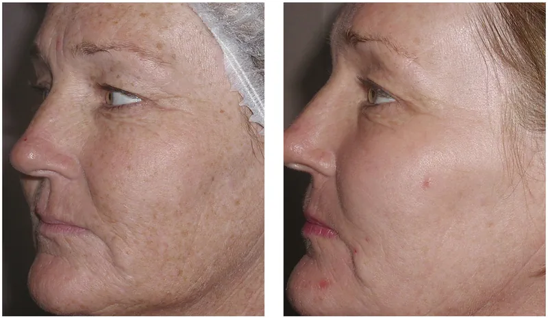 Fraxel LAser Freckles Treatment Before and After
