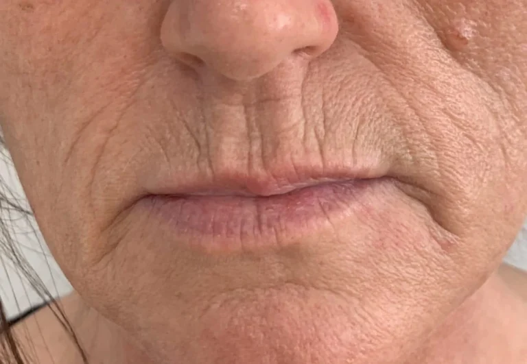 Лечение морщин вокруг рта в Вене. Губные морщины, морщины верхней губы