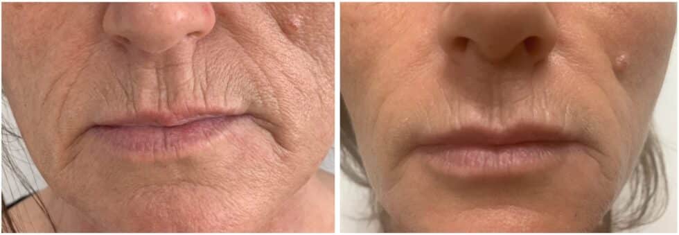 Treat mouth wrinkles before-after