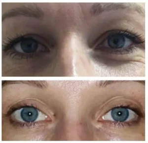 Plasma Pen Lower Eyelid Penetration