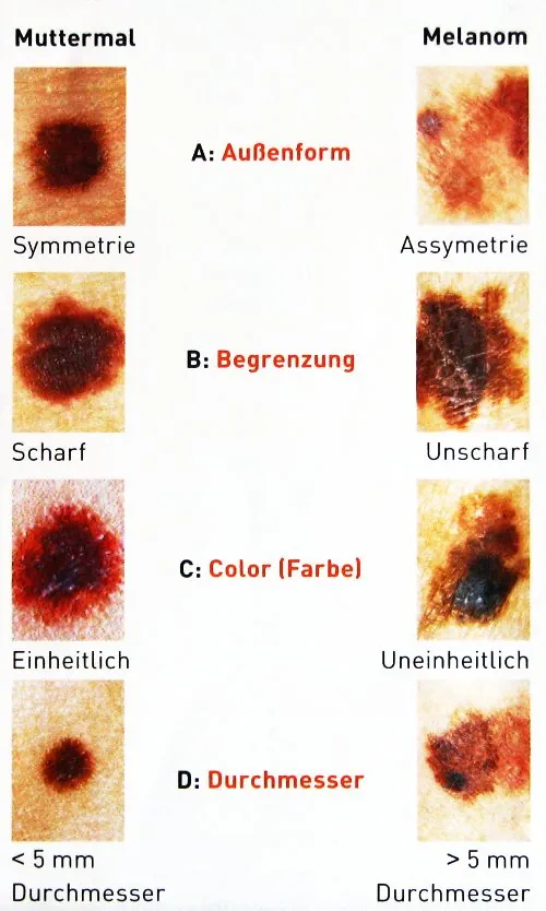 Muttermal - Melanom Vergleichstabelle