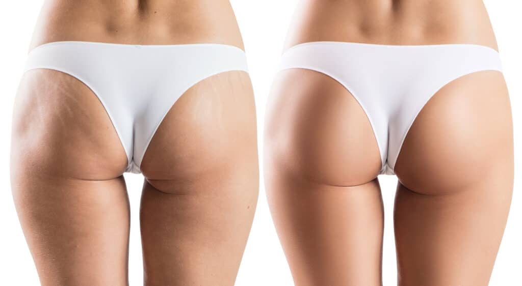 Cellulite can be treated well with ultrasound cavitation