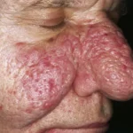Rhinophym behandeln lassen. Schnapsnase behandeln.