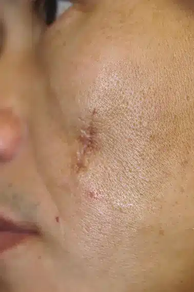 facial scar before