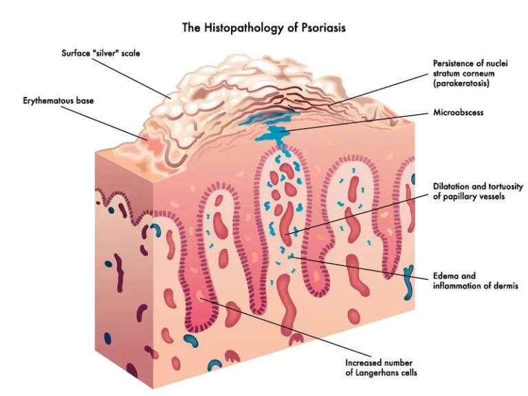 Histopathologie Psoriasis - Schuppenflechte