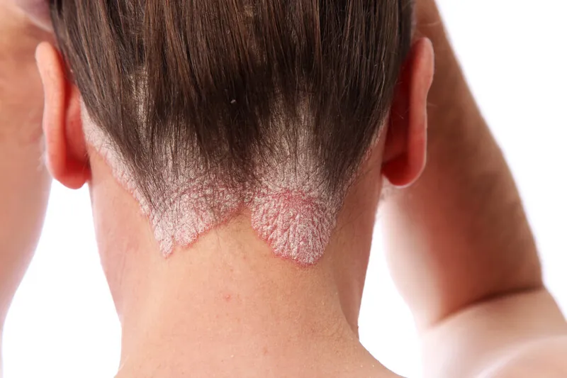 Schuppenflechte Behandlung Wien und Tulln - Schuppenflechte (Psoriasis) am Haaransatz