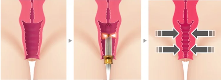 Vaginal tightening with the laser