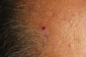 White skin cancer -Actinic keratosis