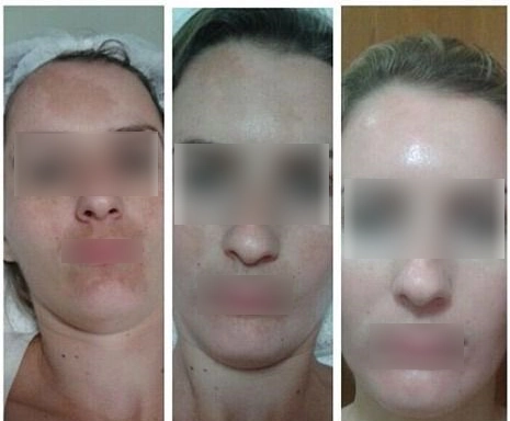 Remove pigmentation spots with Fraxel laser and peeling