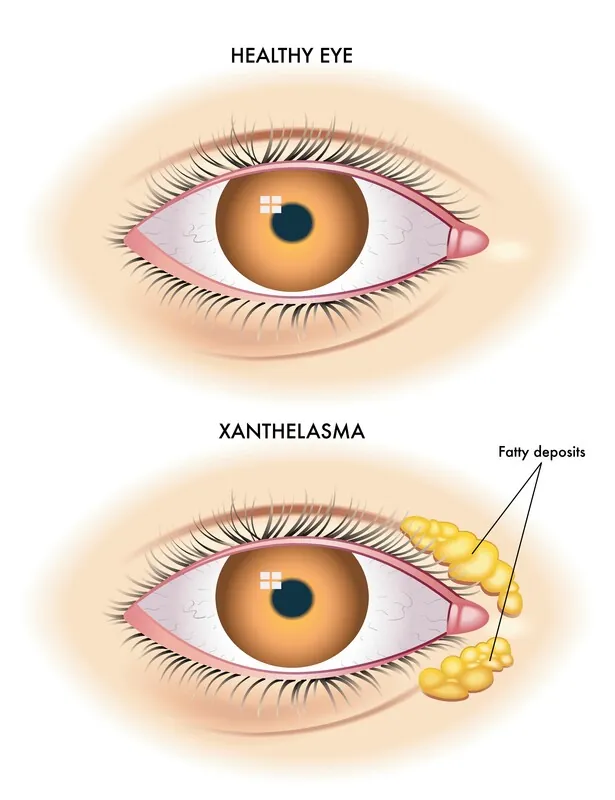 Removing Xanthelasma at the Dermatologist