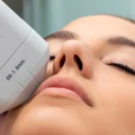 Cryo Hifu Behandlung