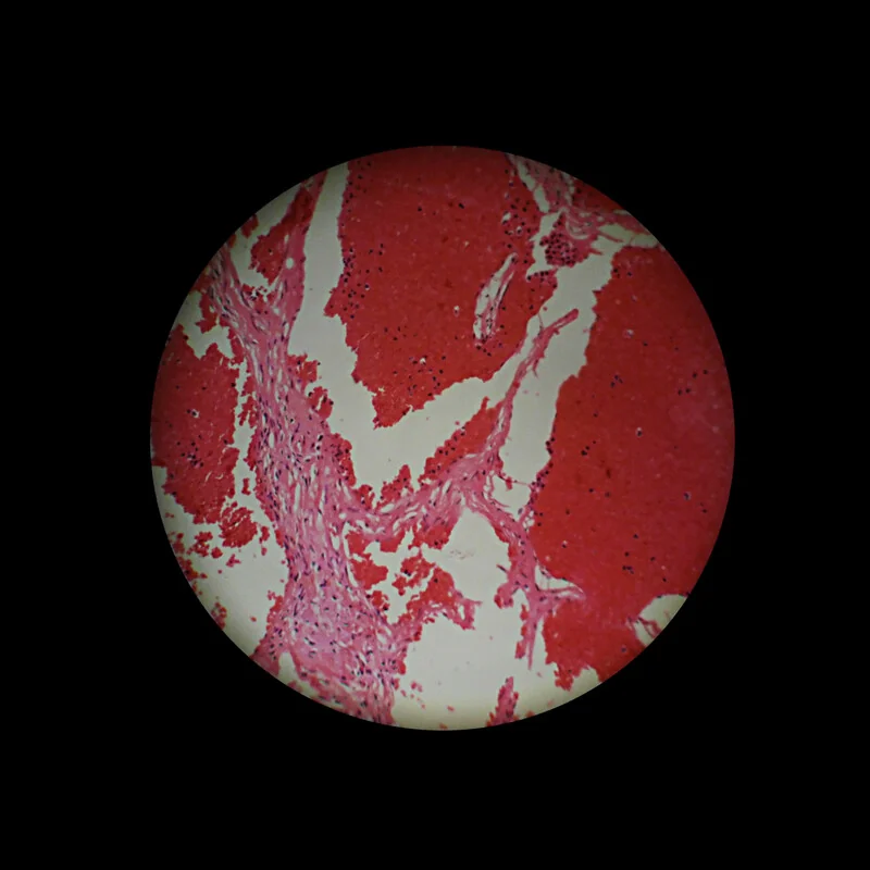 Микроскопическое изображение гемангиомы