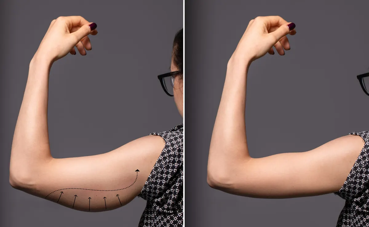 Upper arm lift without surgery in Vienna