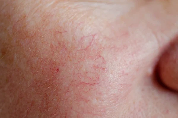 Couperosis: Small, red veins on the face.