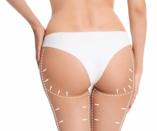 Liposuction -Liposuction Vienna