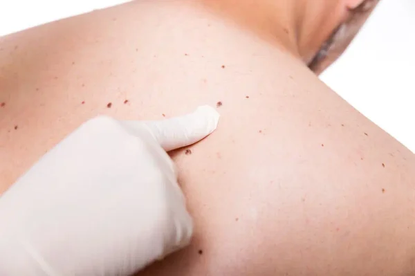 Skin cancer screening and birthmark removal in Vienna