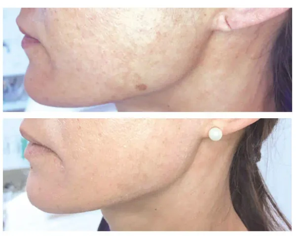 Removing pigmentation spots with the Plasma Pen