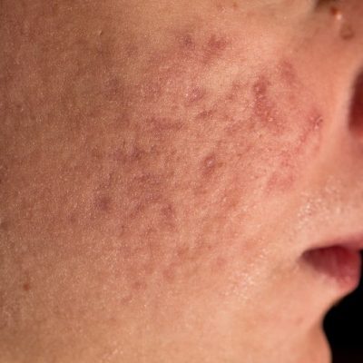 Лечение акне в Вене с помощью неинвазивной лазерной терапии. Удаление акне и шрамов.