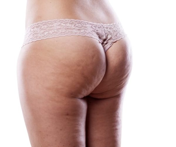 cellulite (orange peel skin) treatment in the practice of Dr. Orasche in Vienna and Tulln