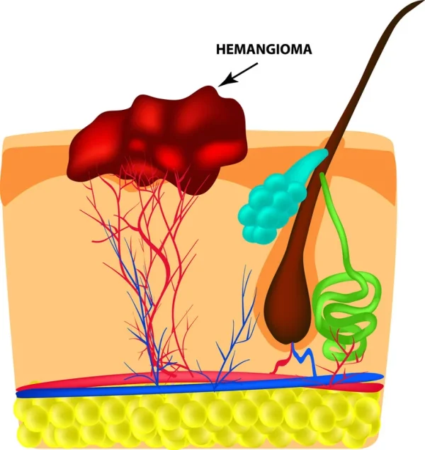 Have a haemangioma removed in Vienna. Cross-section image of a haemangioma or haemangioma.