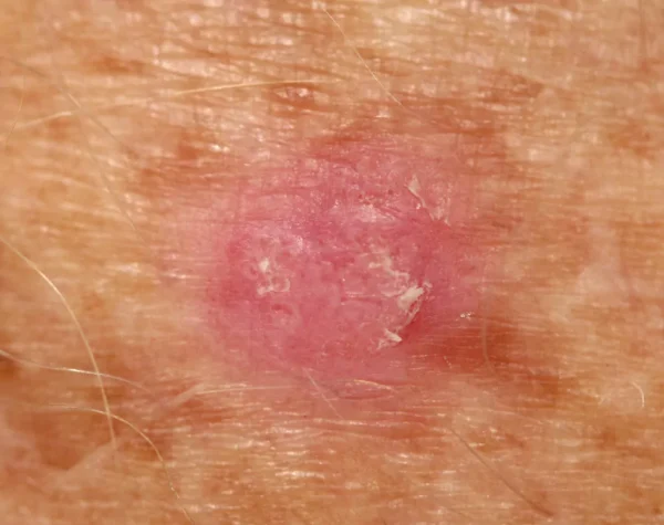 tratamiento del cáncer de piel blanca con TFD diurna